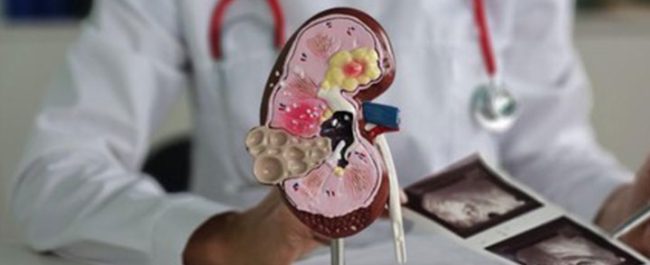 Ilustrasi organ ginjal dan pasien menjalani hemodialisis akibat gagal ginjal